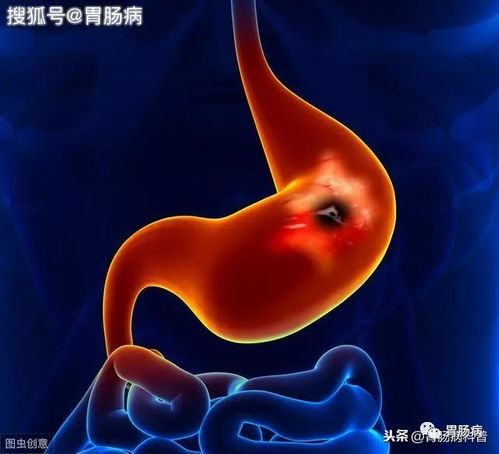 幽门螺旋菌怎样根治? 幽门螺旋菌怎样根治?