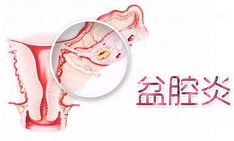 这肚子疼，慢性盆腔炎，肚子每天都会疼，怎么办？慢性盆腔炎如何根治