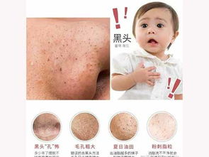 如何清洗脸部黑头?如何清洁脸上的黑头