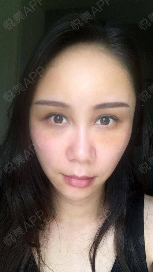 全麻后如何苏醒?全麻后如何苏醒