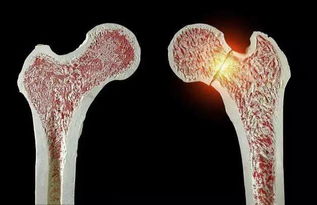 骨折后如何饮食?骨折后饮食应该注意什么 骨折后如何饮食?骨折后饮食应该注意什么