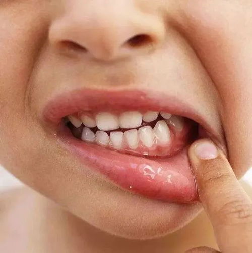 如何让牙根松动?如何让牙根快速脱落