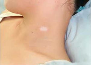 白巅峰如何治疗最好?白巅峰发病后都有什么症状表现