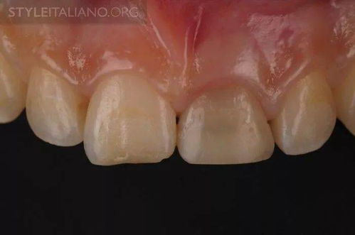 如何修复纤维环?怎么修复纤维环