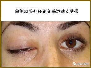 如何看瞳孔大小?如何看瞳孔大小及对光反射