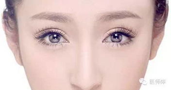 如何消除双眼皮肿胀?割双眼皮肿胀期多久