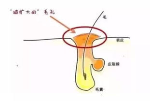 皮下积液如何治?皮下积液多长时间能好