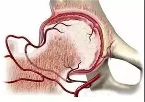 早期股骨头如何治疗?早期股骨头怎么治疗