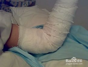 骨折伤口如何快速愈合?骨折之后如何锻炼伤口愈合