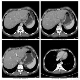 ct片如何看淋巴结?ct淋巴结大小如何测量