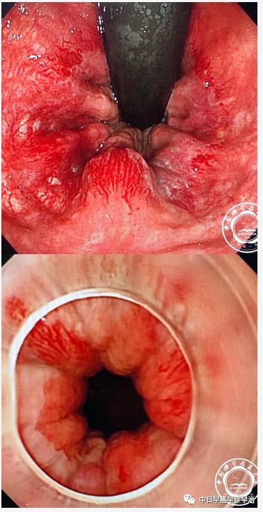 内痔疮如何诊断?内痔疮如何诊断出来