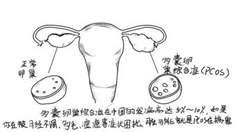 多囊卵巢体毛多如何治?多囊体毛重怎么办