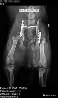 骨盆骨折如何搬运图片?骨盆骨折怎么康复训练后期