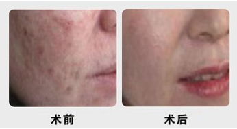 腿上的疤痕如何去除?腿上的疤痕如何去除掉