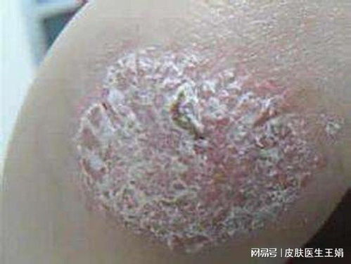 如何治好体癣?怎么根治体癣