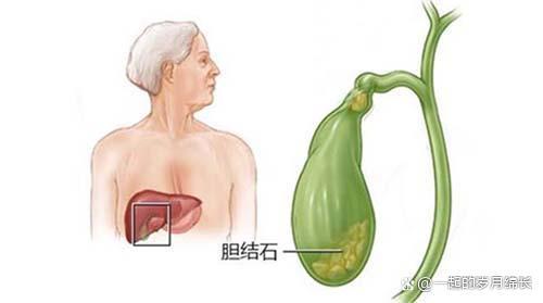 胆囊壁粗糙如何治疗?胆囊壁粗糙如何治疗好