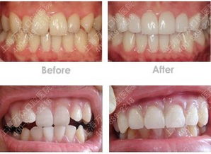 南方医院矫正牙齿如何?南方医院 牙科