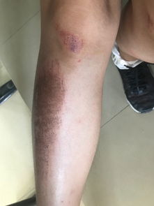 面部擦伤红印是疤痕么如何消除?面部擦伤留下的印子怎么去除