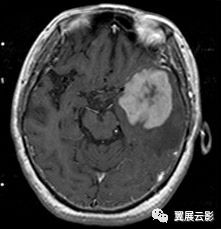 如何区分颅内囊肿和肿瘤?颅内肿瘤和囊肿的区别
