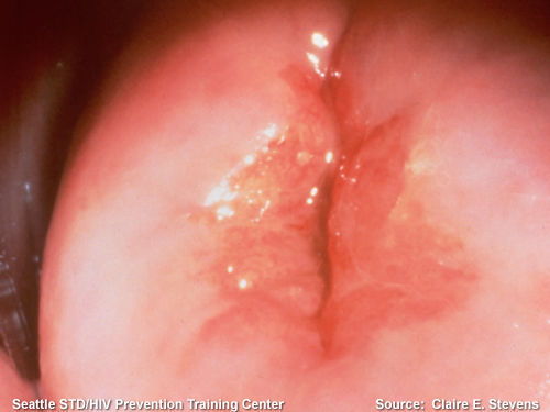 宫颈糜烂如何治疗?宫颈糜烂如何治疗天涯论坛