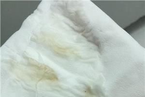 如何区分羊水和分泌物?如何区分羊水和分泌物图片