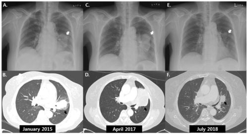 强迫症重复的思维如何摆脱?强迫症自愈指南,走出重复怪圈