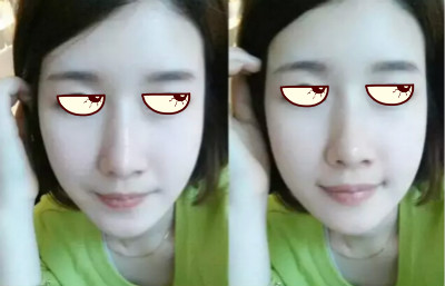 如何修复脸部坑洼?如何修复脸部坑洼凹陷