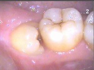 拔智齿后如何刷牙?拔完智齿怎样刷牙