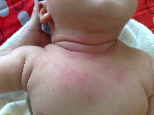 痱子如何止痒?痱子止痒的方法小妙招