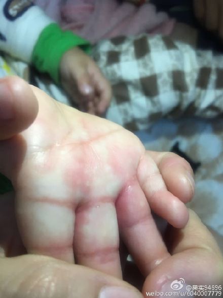 如何淡化伤口色素?淡化伤口色素沉着最好的药膏